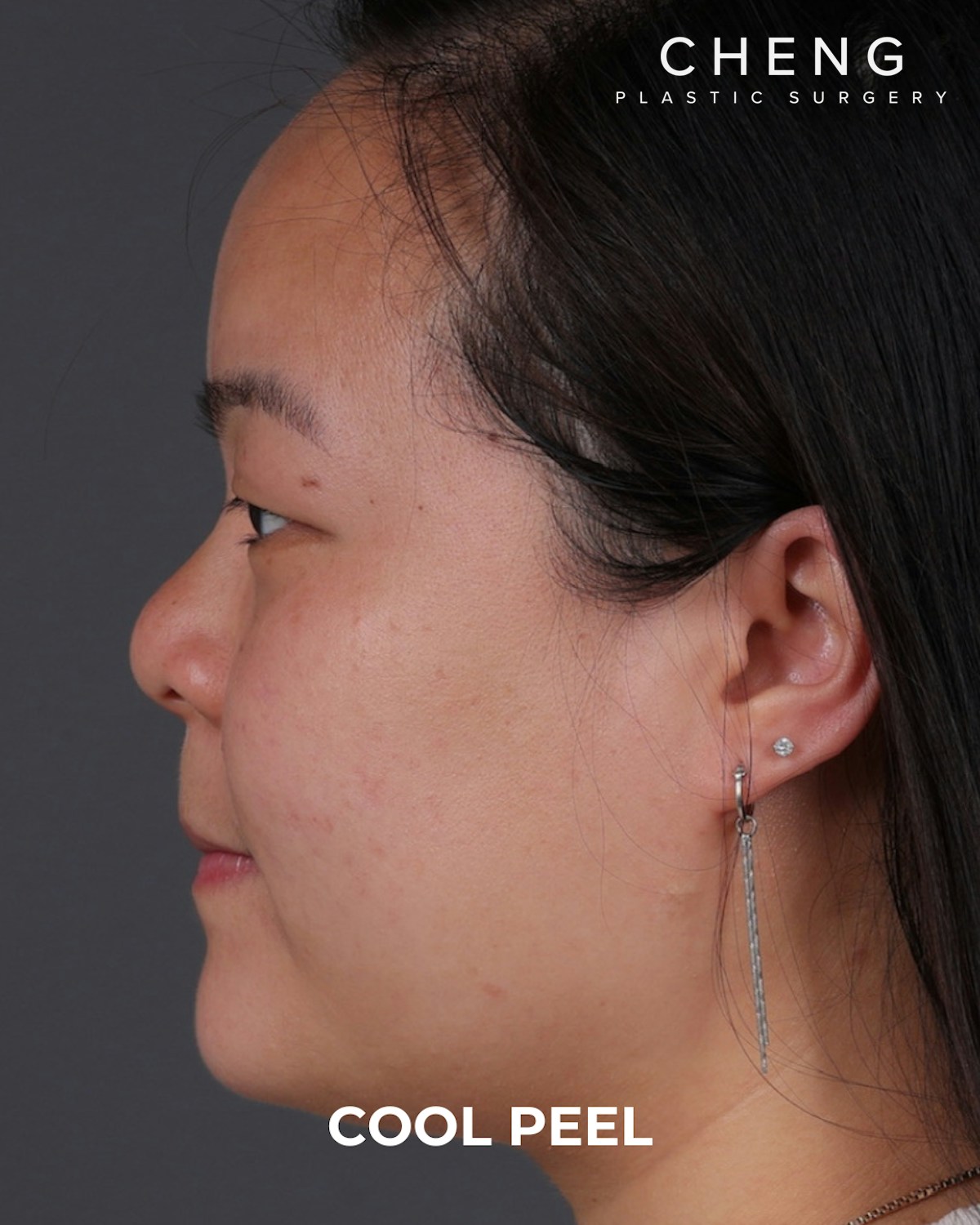 Co2 Laser Before & After Gallery - Patient 416341 - Image 10