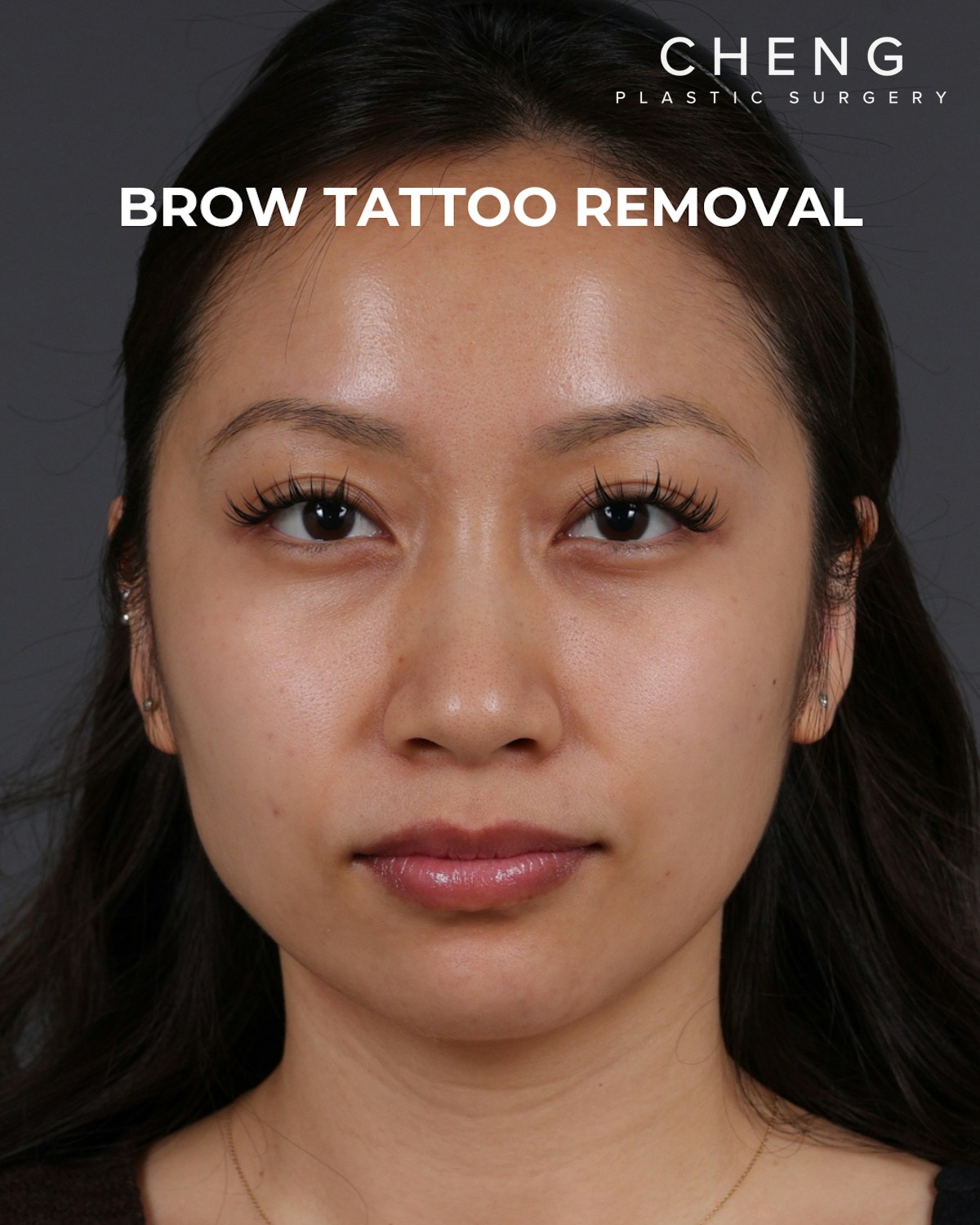Brow Tattoo Removal Before & After Gallery - Patient 179499 - Image 2