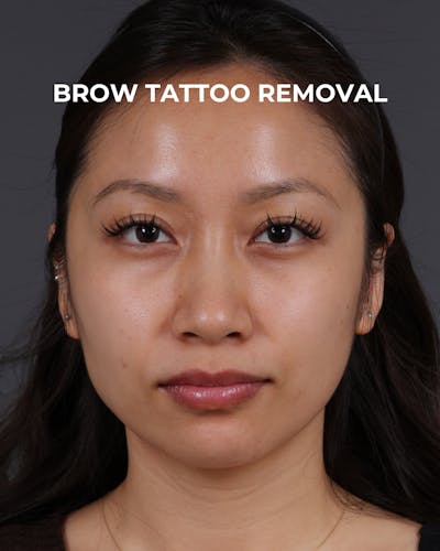 Brow Tattoo Removal Before & After Gallery - Patient 179499 - Image 2