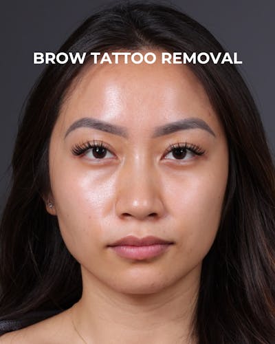 Brow Tattoo Removal Before & After Gallery - Patient 179499 - Image 1