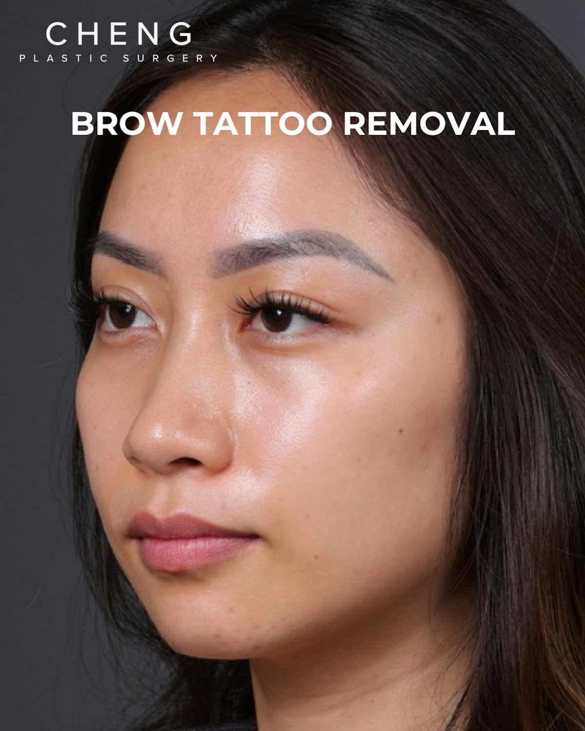 Brow Tattoo Removal Before & After Gallery - Patient 179499 - Image 5