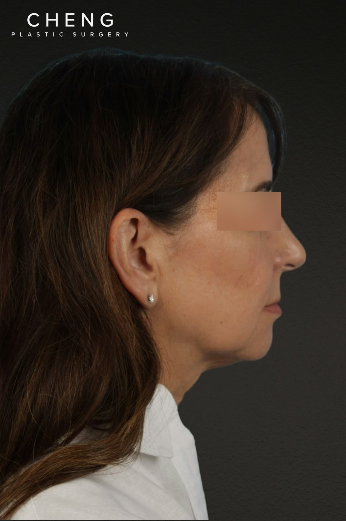 Neck Lift Before & After Gallery - Patient 428433 - Image 5