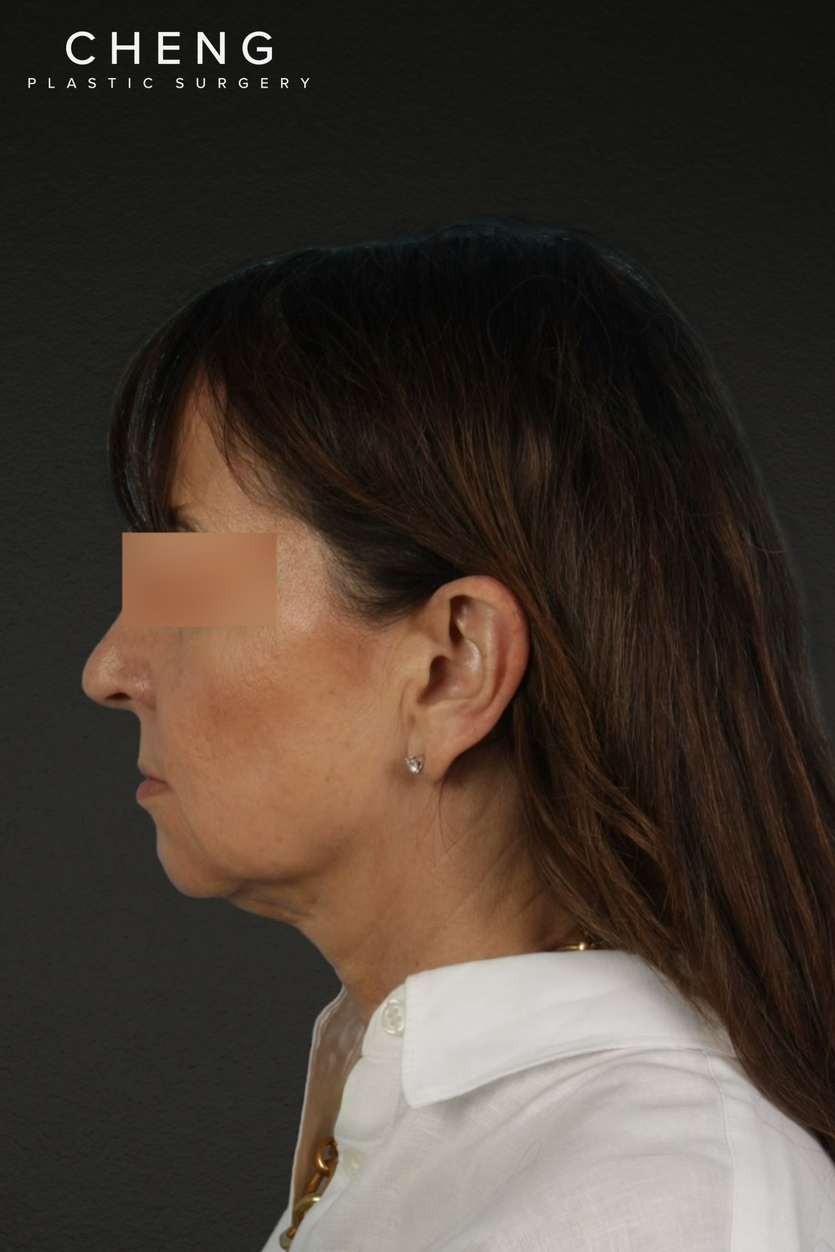 Neck Lift Before & After Gallery - Patient 428433 - Image 9