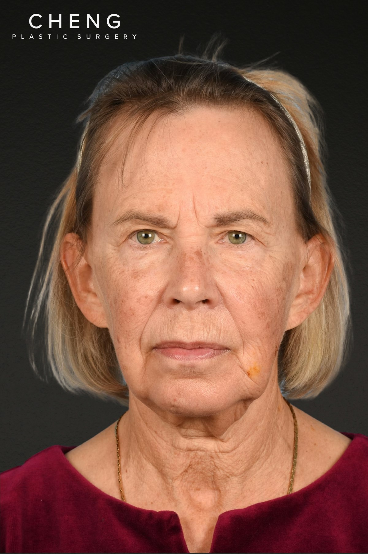 Neck Lift Before & After Gallery - Patient 310482 - Image 1