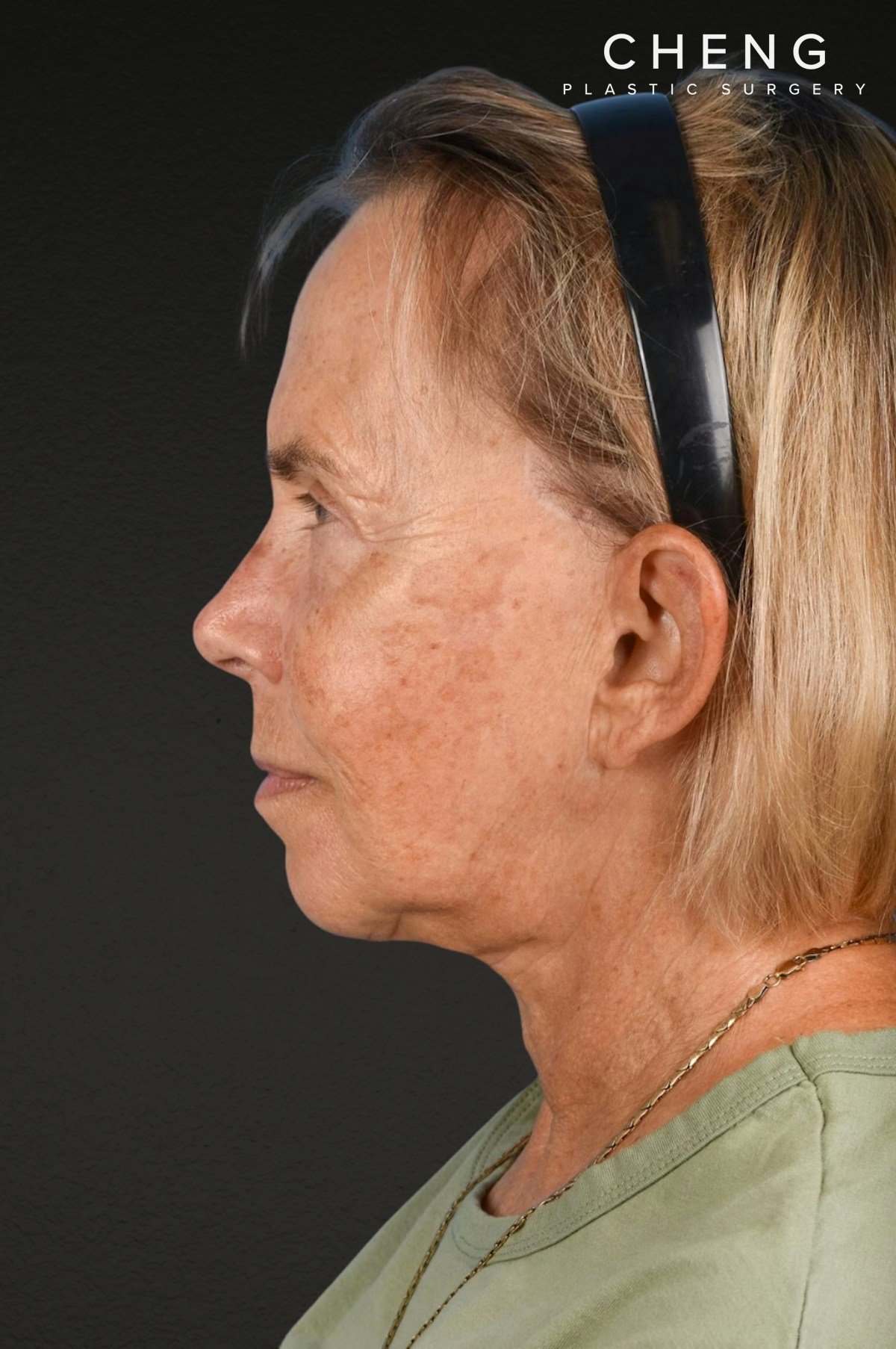 Neck Lift Before & After Gallery - Patient 310482 - Image 6