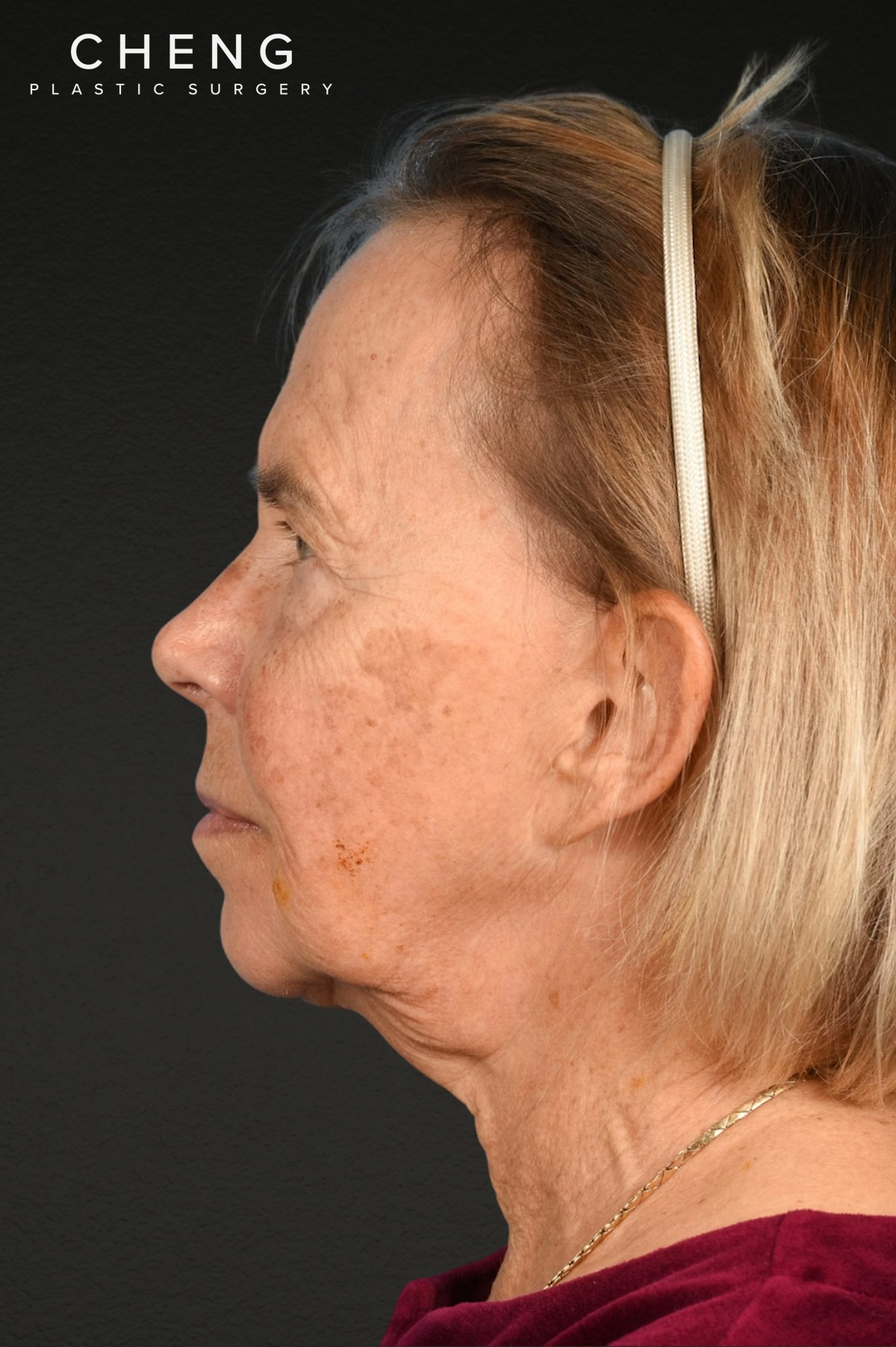 Neck Lift Before & After Gallery - Patient 310482 - Image 5