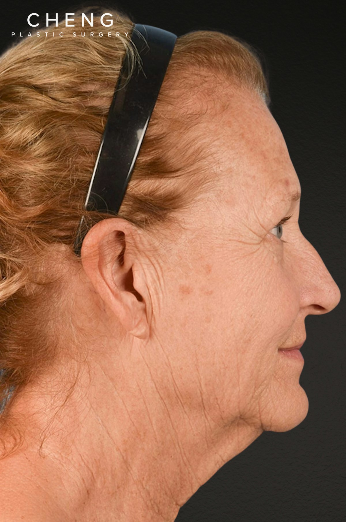 Neck Lift Before & After Gallery - Patient 302253 - Image 5