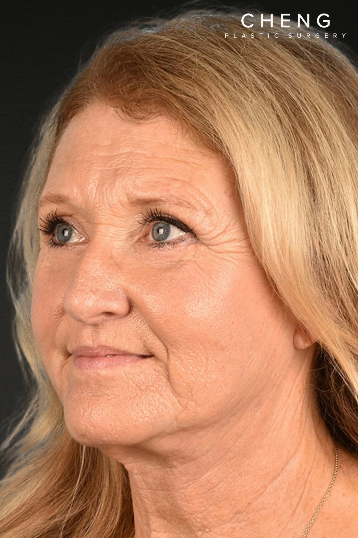 Neck Lift Before & After Gallery - Patient 302253 - Image 4