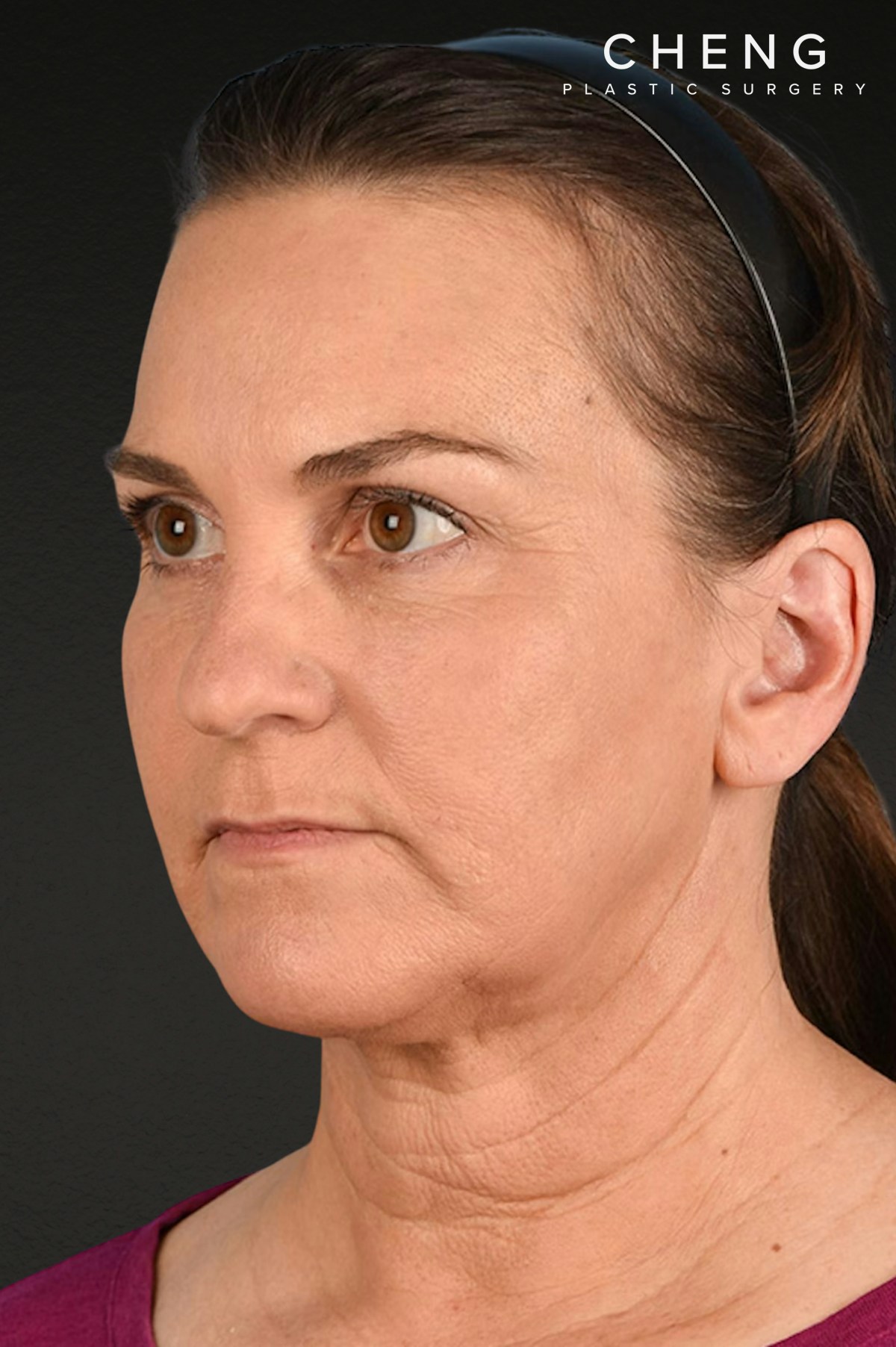Neck Lift Before & After Gallery - Patient 169561 - Image 8