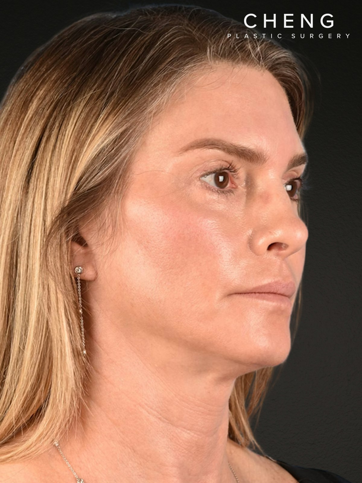 Neck Lift Before & After Gallery - Patient 223130 - Image 4