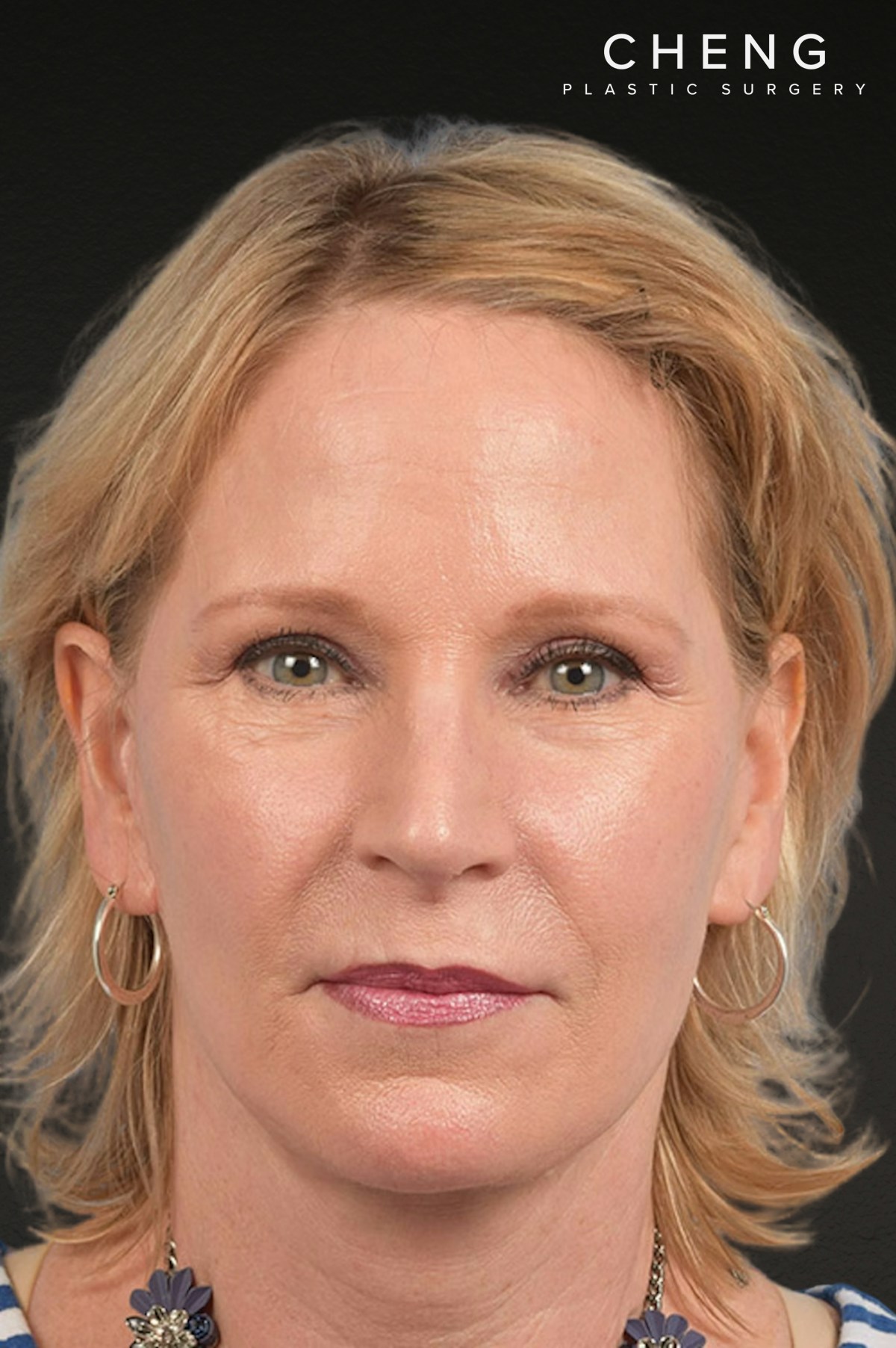Neck Lift Before & After Gallery - Patient 250758 - Image 2