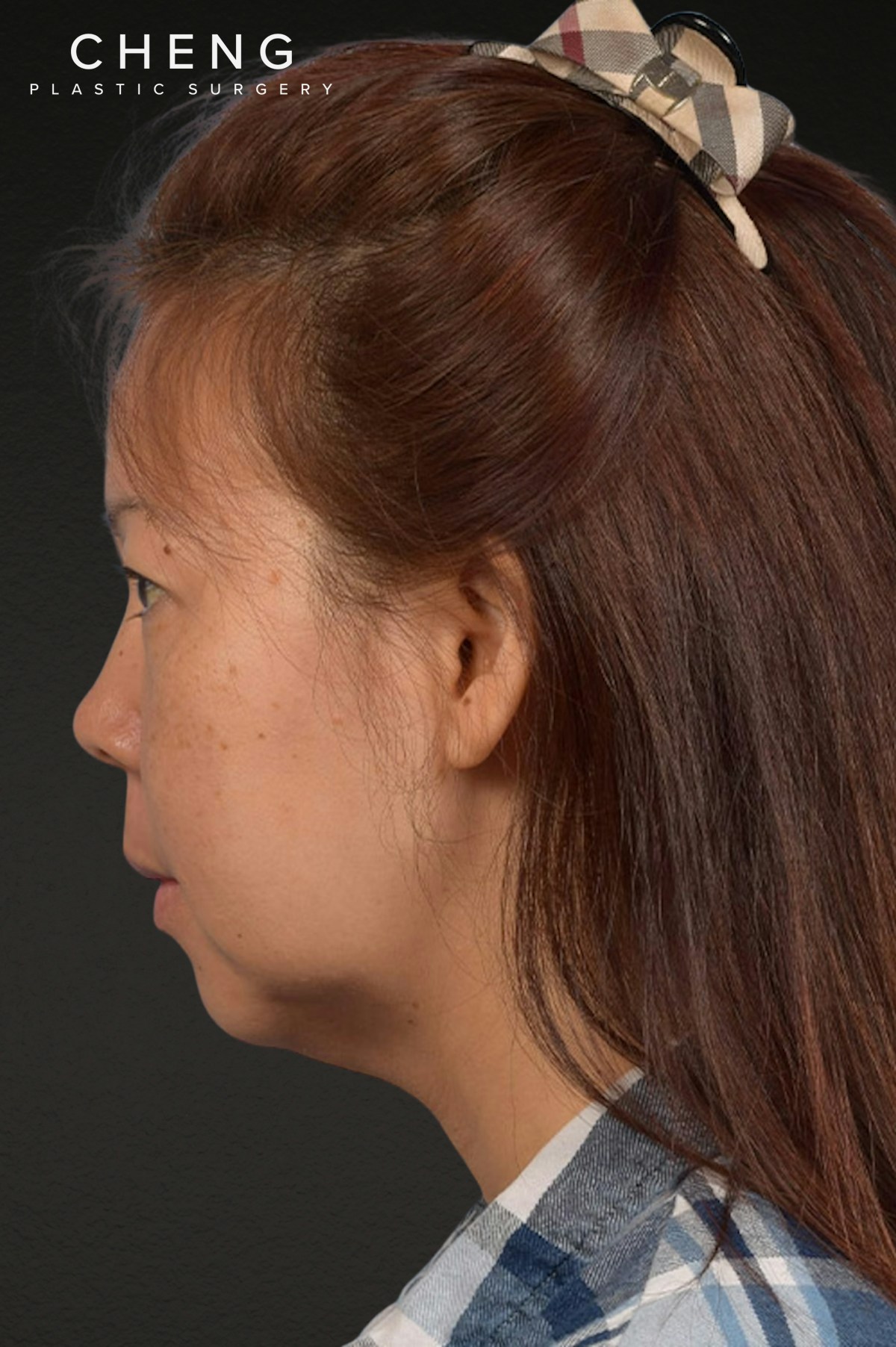Neck Lift Before & After Gallery - Patient 289705 - Image 9