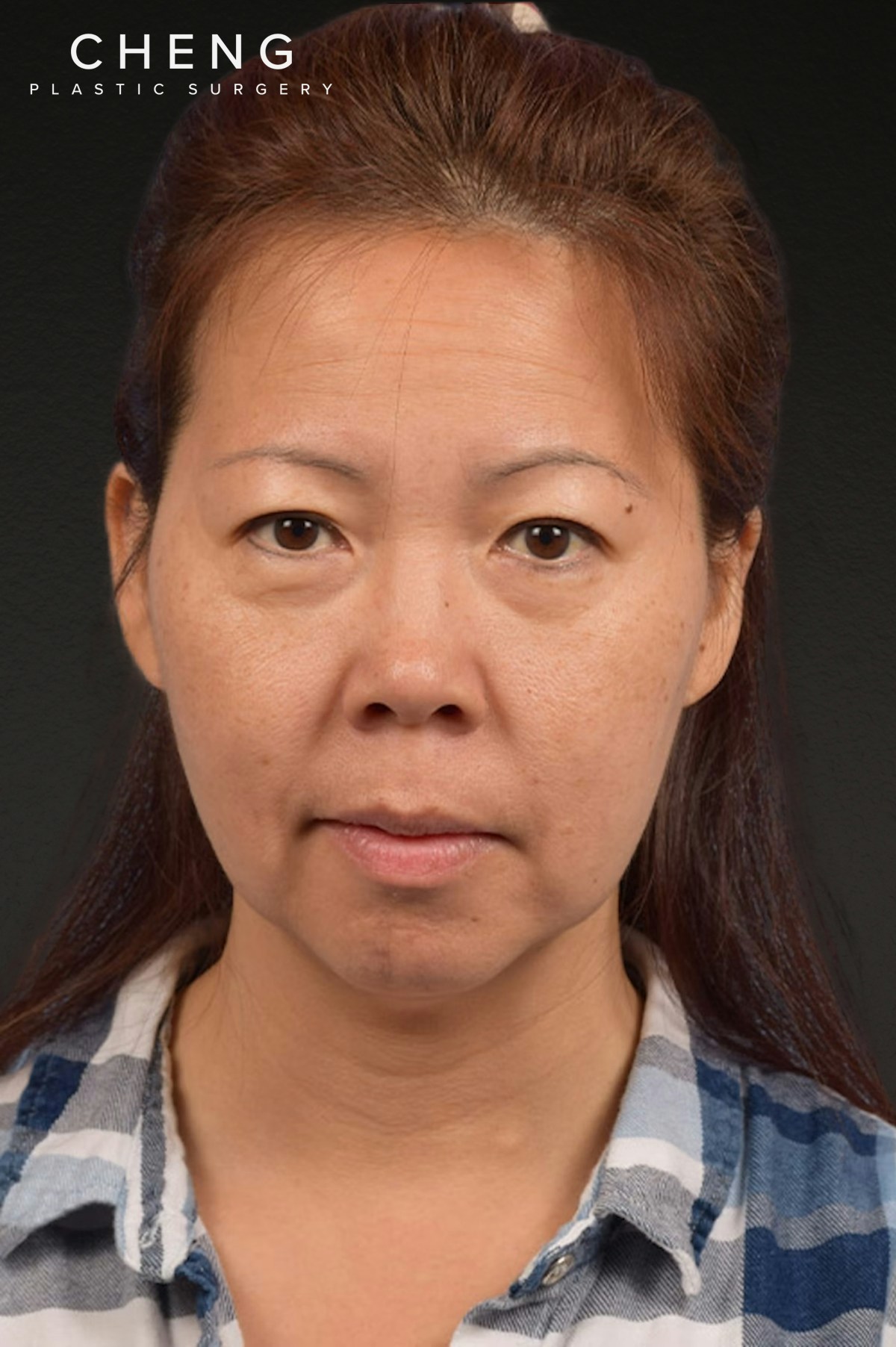 Neck Lift Before & After Gallery - Patient 289705 - Image 1