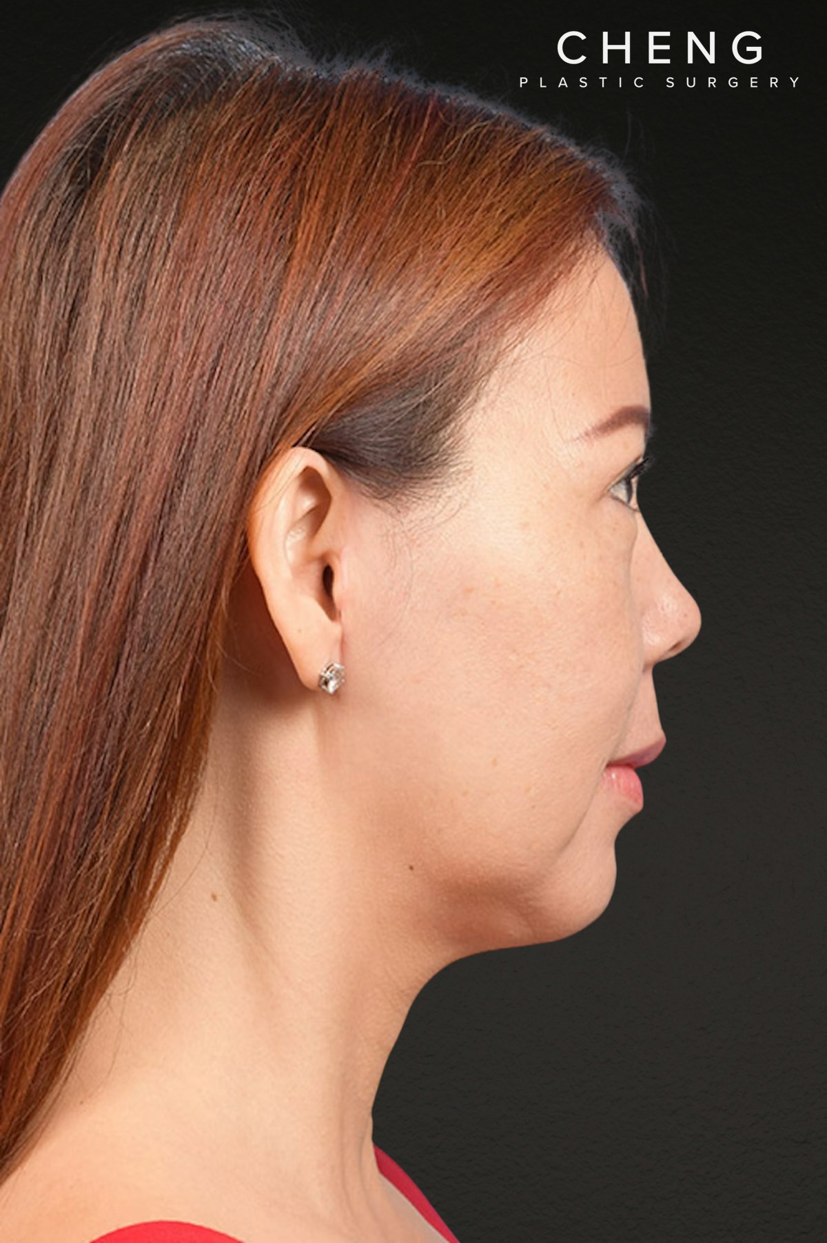 Neck Lift Before & After Gallery - Patient 289705 - Image 6