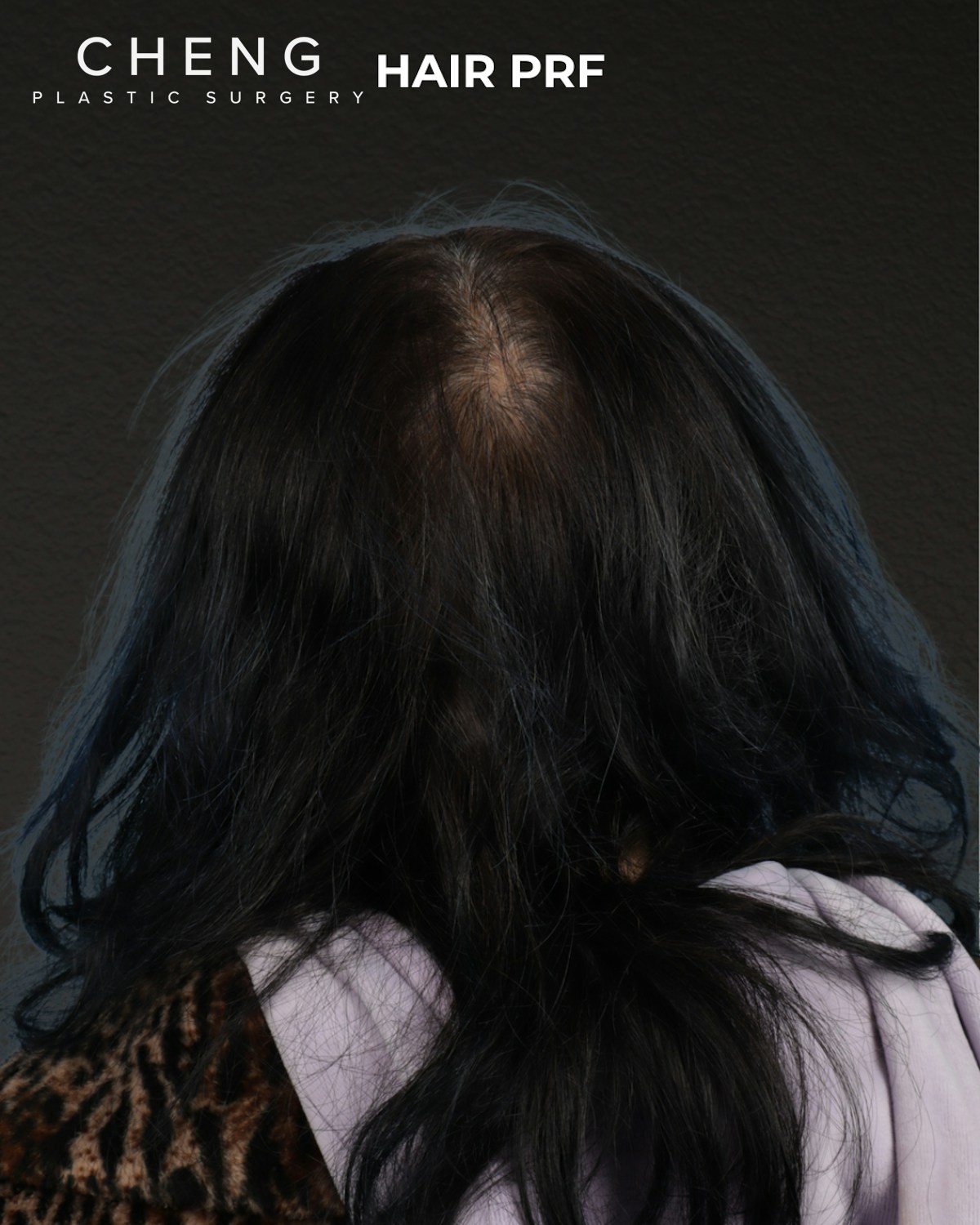 Hair Rejuvenation With PRP Before & After Gallery - Patient 118949 - Image 1