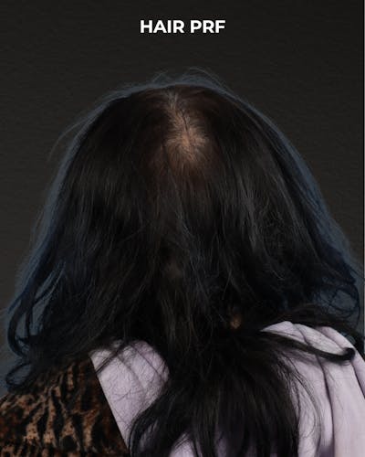 Hair Rejuvenation With PRP Before & After Gallery - Patient 118949 - Image 1