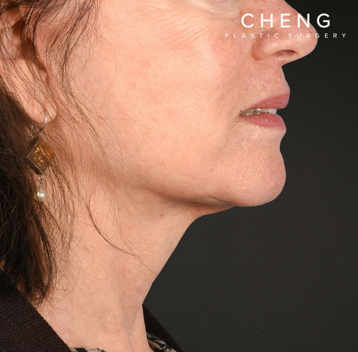 Neck Lift Before & After Gallery - Patient 328488 - Image 8
