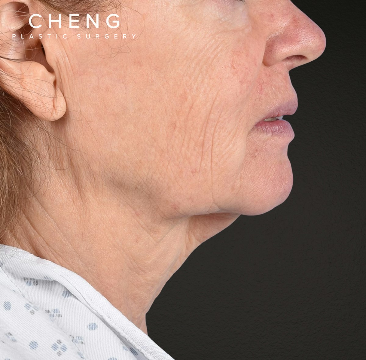 Neck Lift Before & After Gallery - Patient 328488 - Image 7