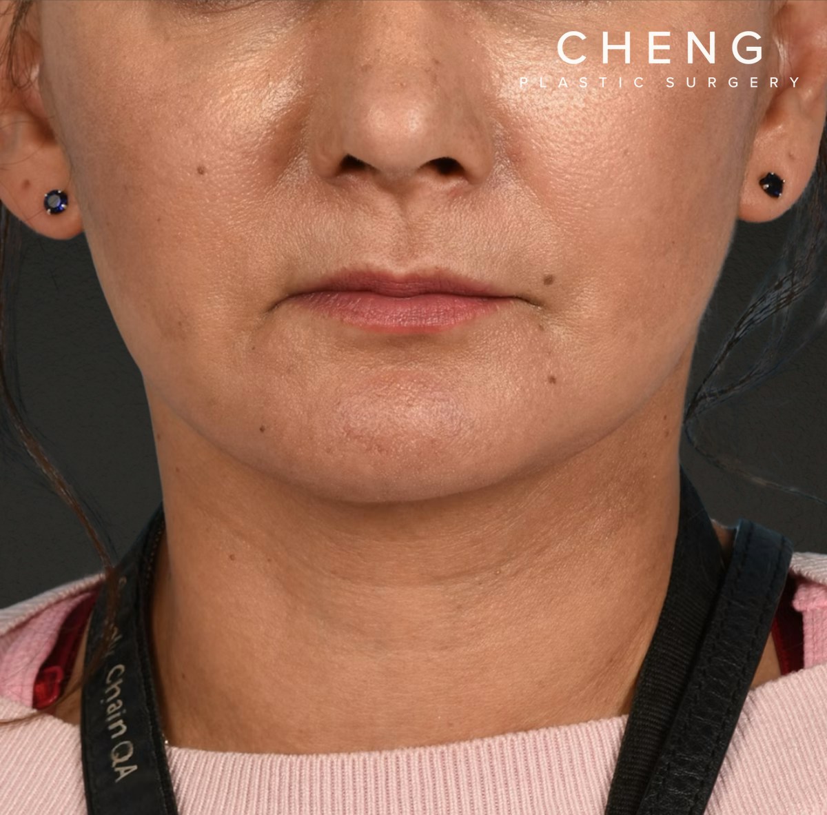 Neck Lift Before & After Gallery - Patient 424030 - Image 2