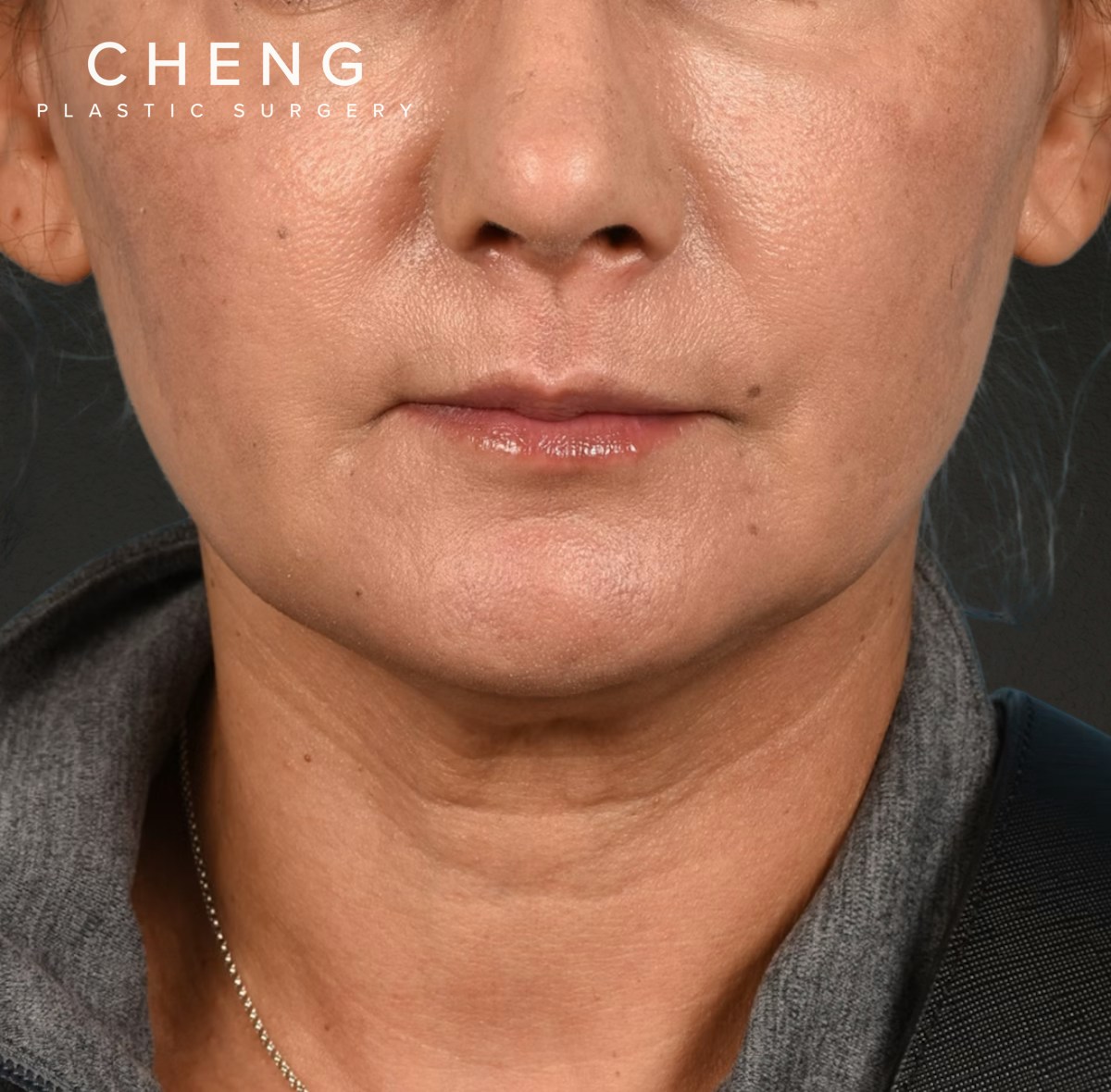 Neck Lift Before & After Gallery - Patient 424030 - Image 1