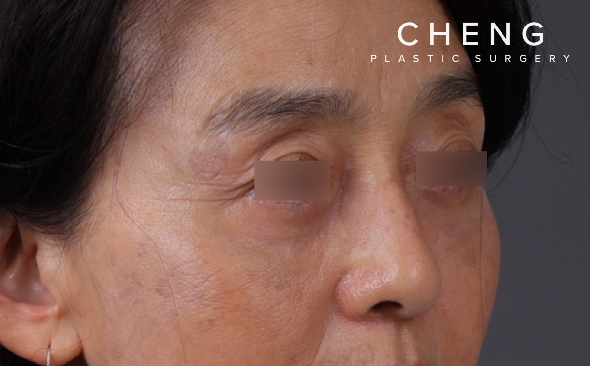 Blepharoplasty Before & After Gallery - Patient 189111 - Image 4