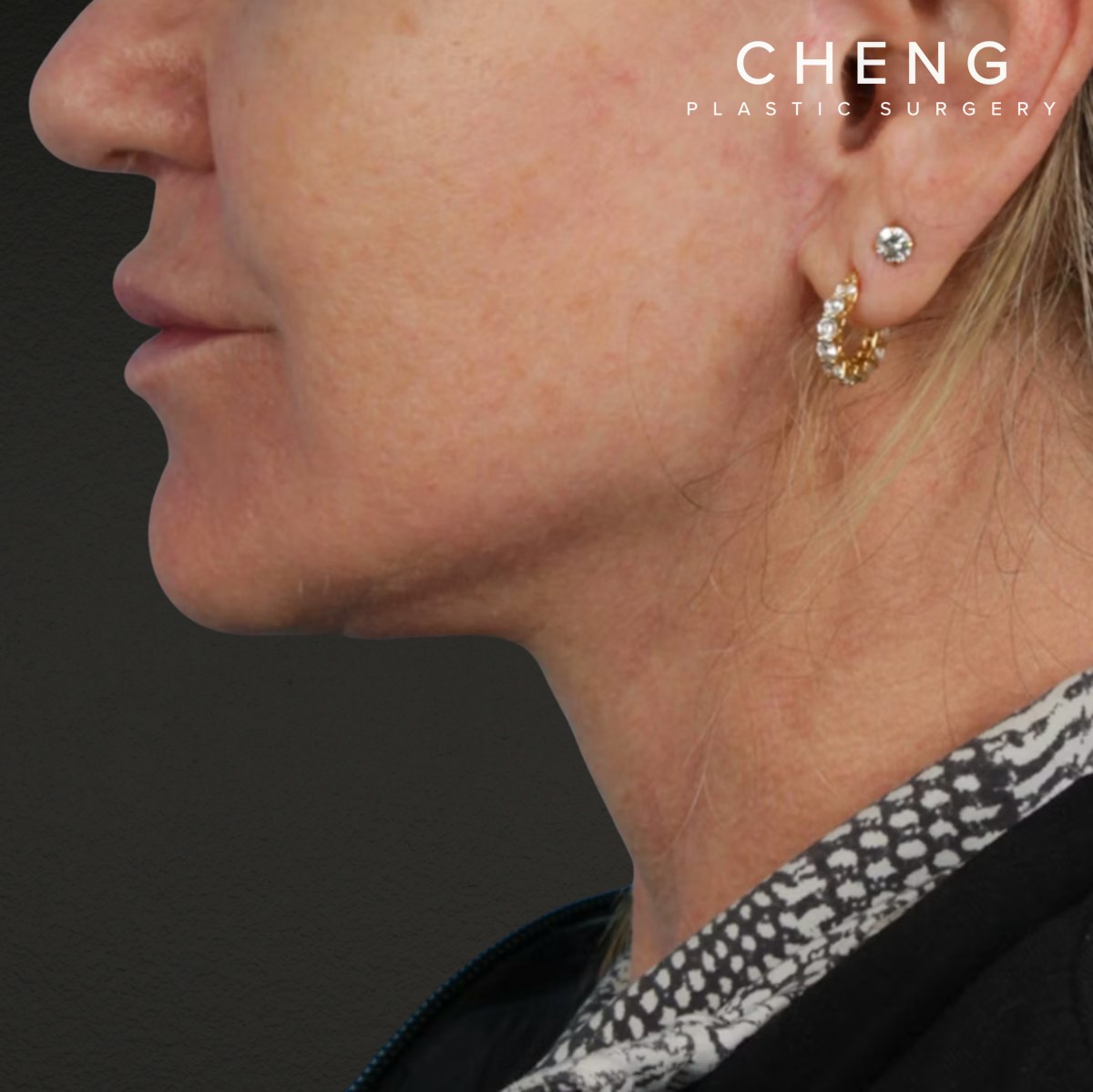 Neck Lift Before & After Gallery - Patient 278784 - Image 6