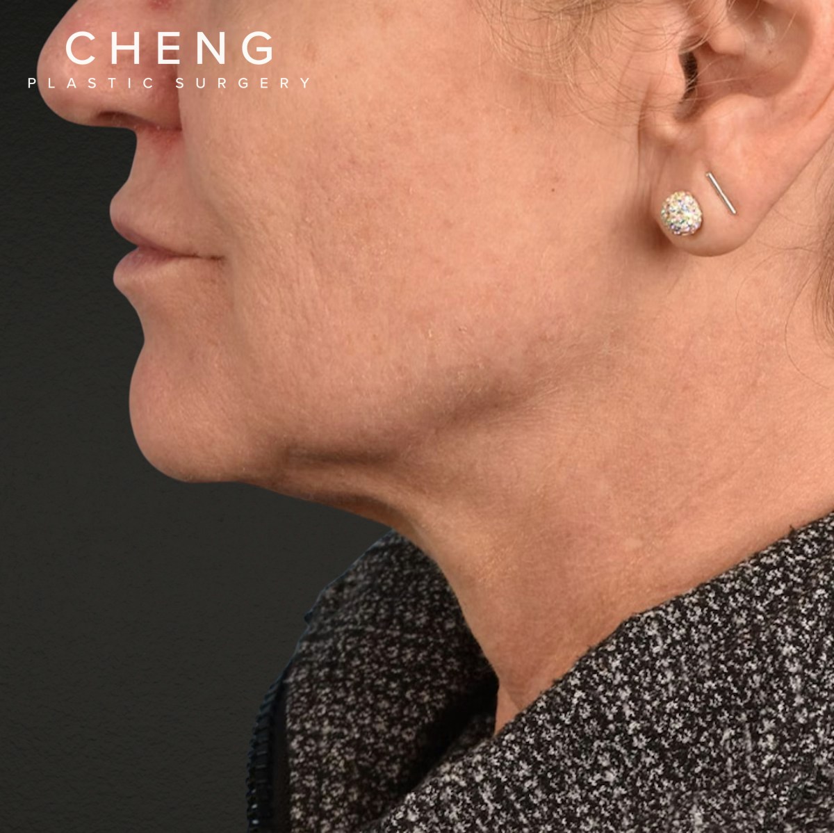 Neck Lift Before & After Gallery - Patient 278784 - Image 5