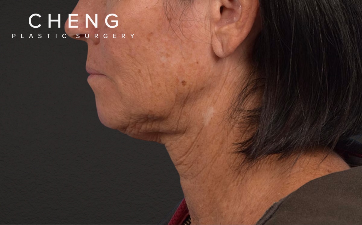 Neck Lift Before & After Gallery - Patient 540880 - Image 5