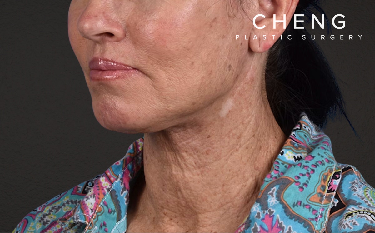 Neck Lift Before & After Gallery - Patient 540880 - Image 4