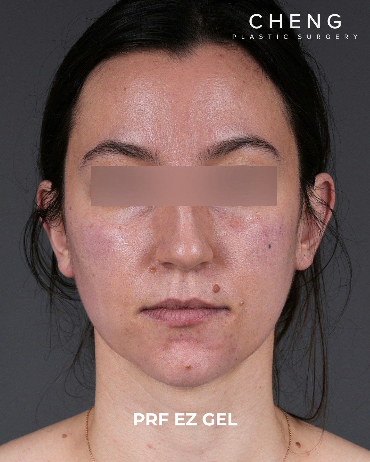 PRF Before & After Gallery - Patient 856119 - Image 2