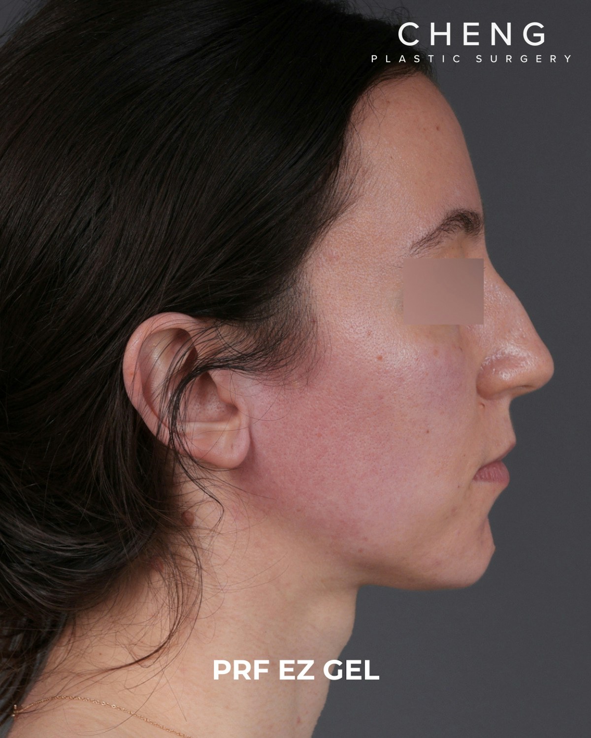 PRF Before & After Gallery - Patient 856119 - Image 6