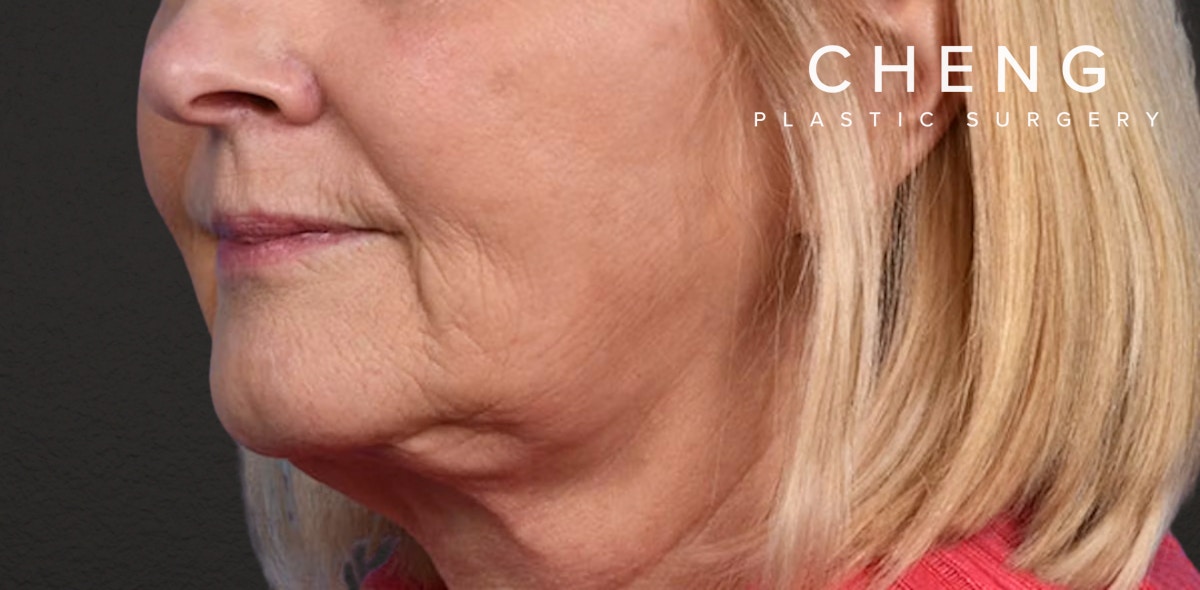 Neck Lift Before & After Gallery - Patient 350287 - Image 4