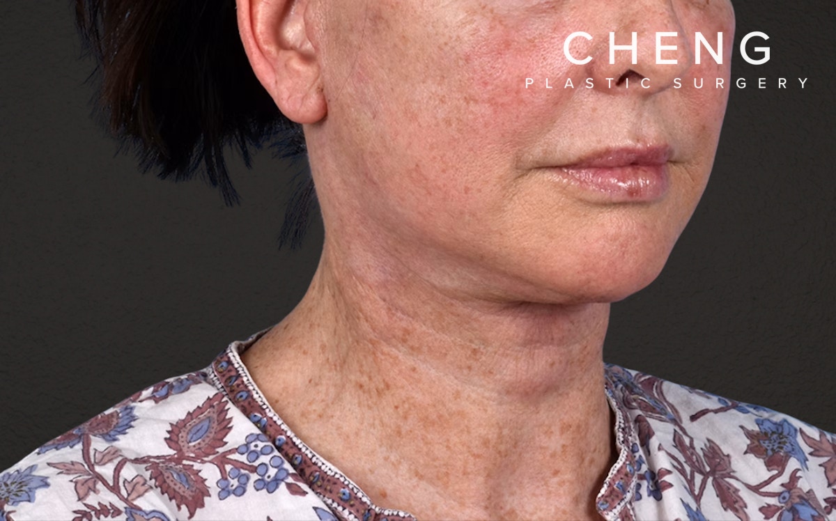 Neck Lift Before & After Gallery - Patient 238925 - Image 4