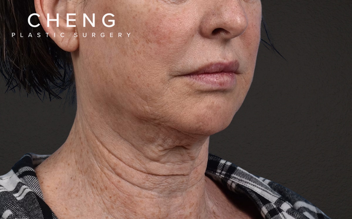 Neck Lift Before & After Gallery - Patient 238925 - Image 3