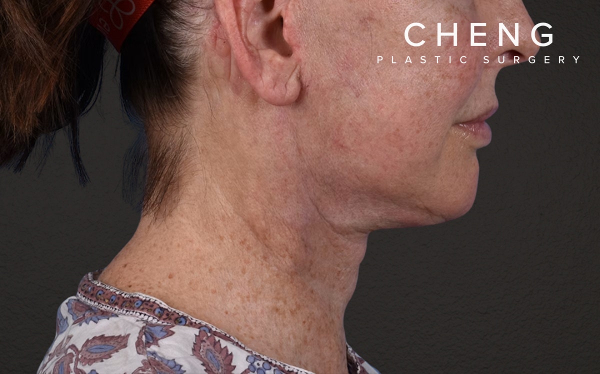 Neck Lift Before & After Gallery - Patient 238925 - Image 6