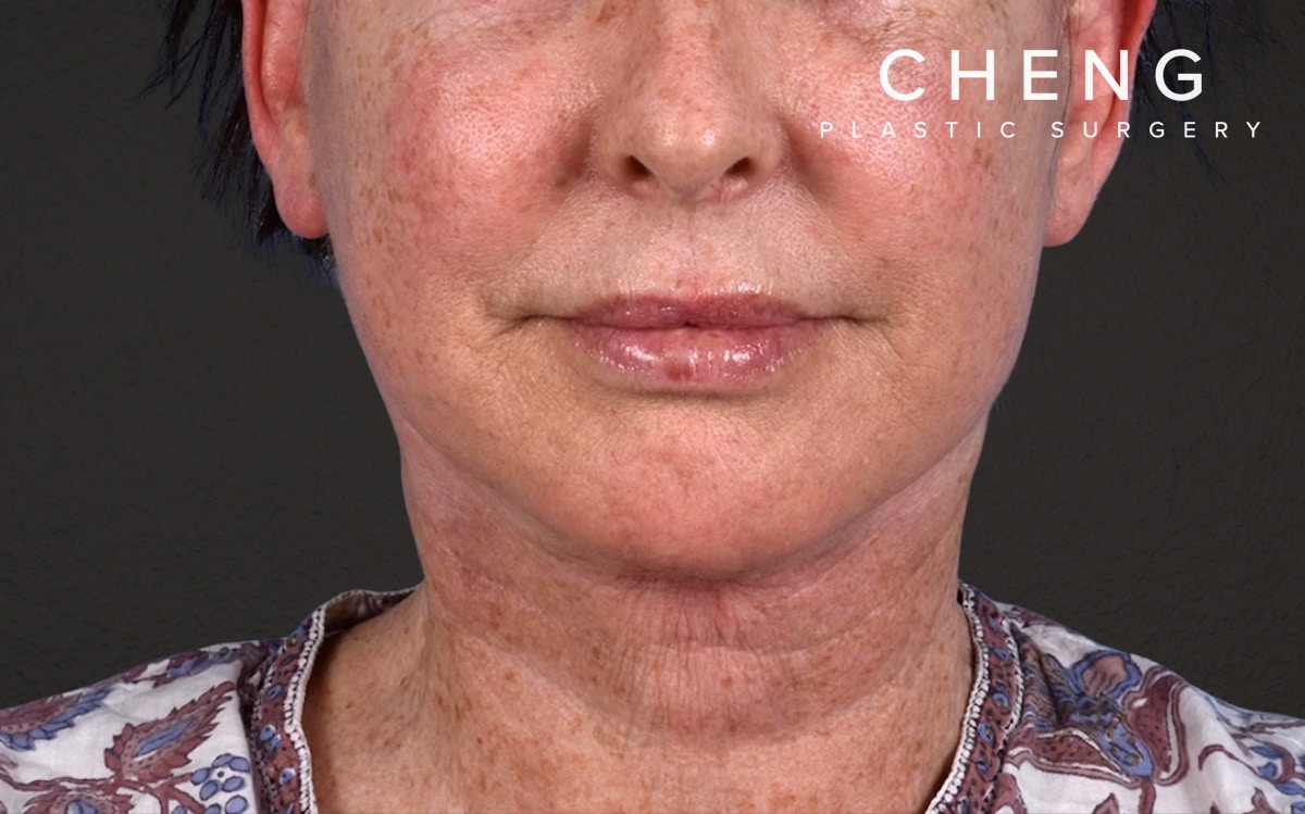Neck Lift Before & After Gallery - Patient 238925 - Image 2