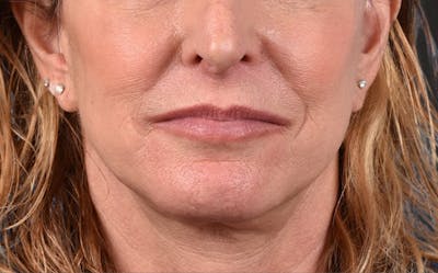 Neck Lift Before & After Gallery - Patient 522152 - Image 2
