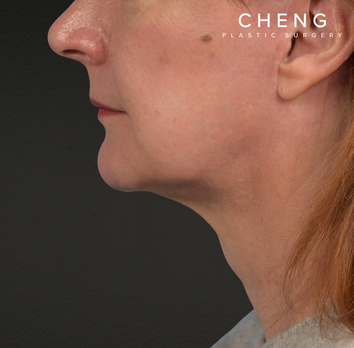 Neck Lift Before & After Gallery - Patient 204140 - Image 10