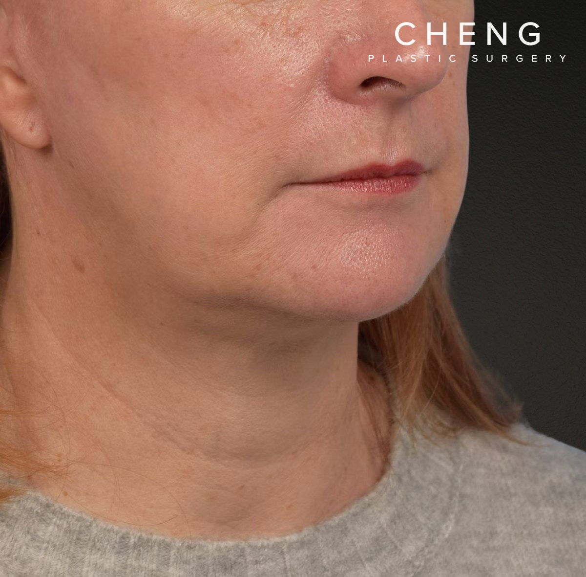 Neck Lift Before & After Gallery - Patient 204140 - Image 4