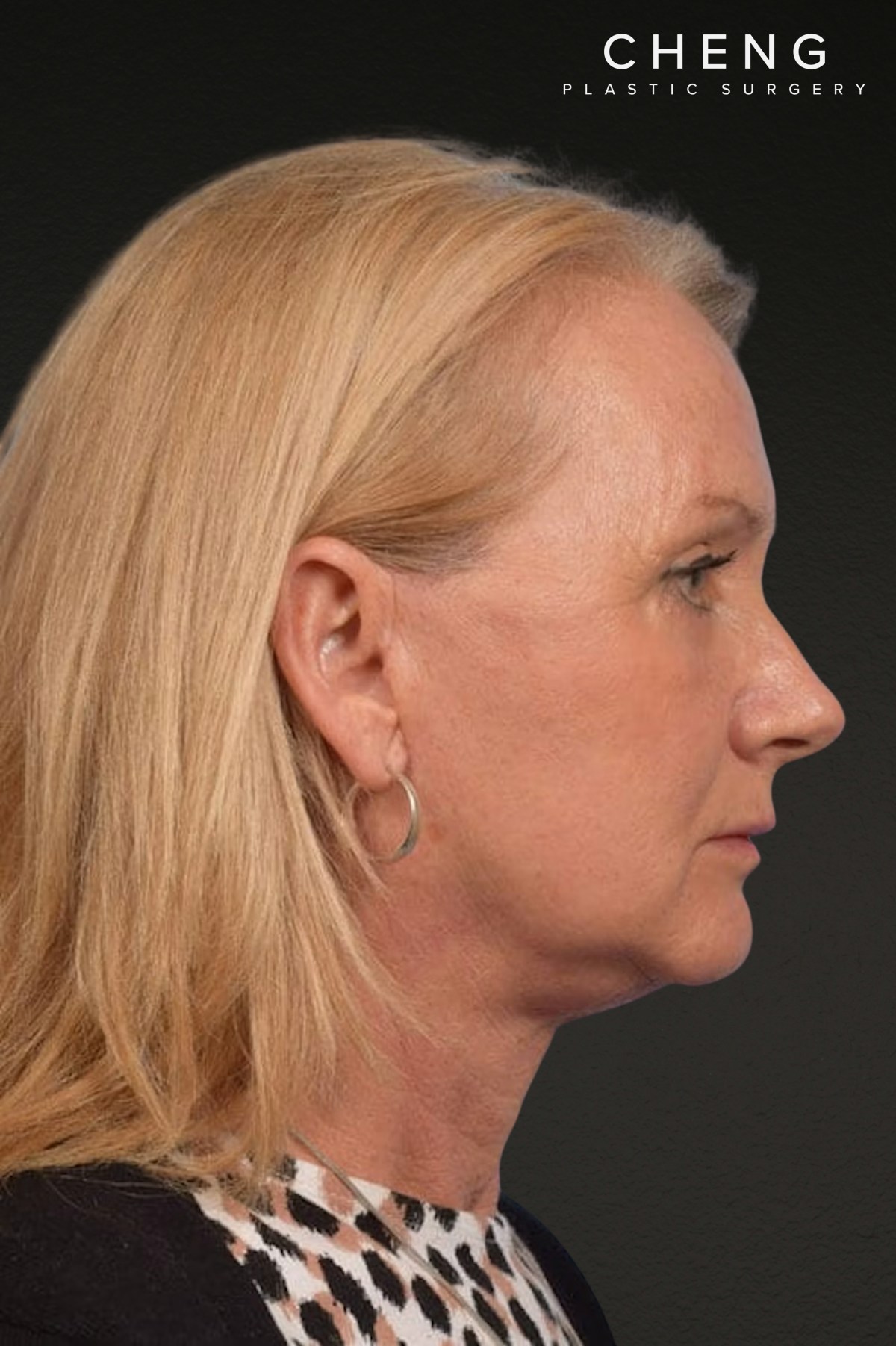 Neck Lift Before & After Gallery - Patient 207141 - Image 4