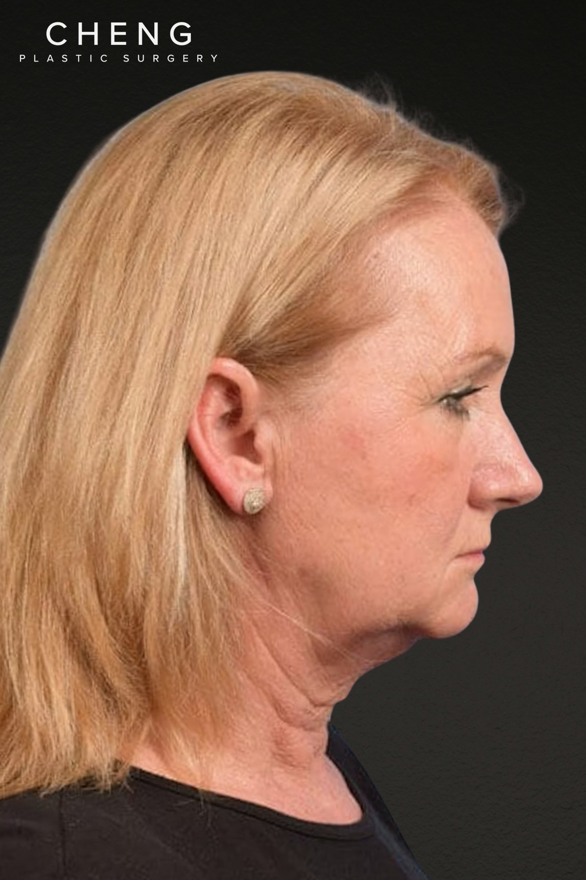 Neck Lift Before & After Gallery - Patient 207141 - Image 3