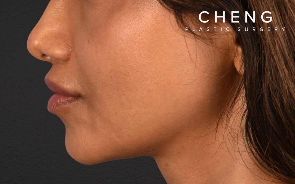 Lip Lift Before & After Gallery - Patient 369454 - Image 6