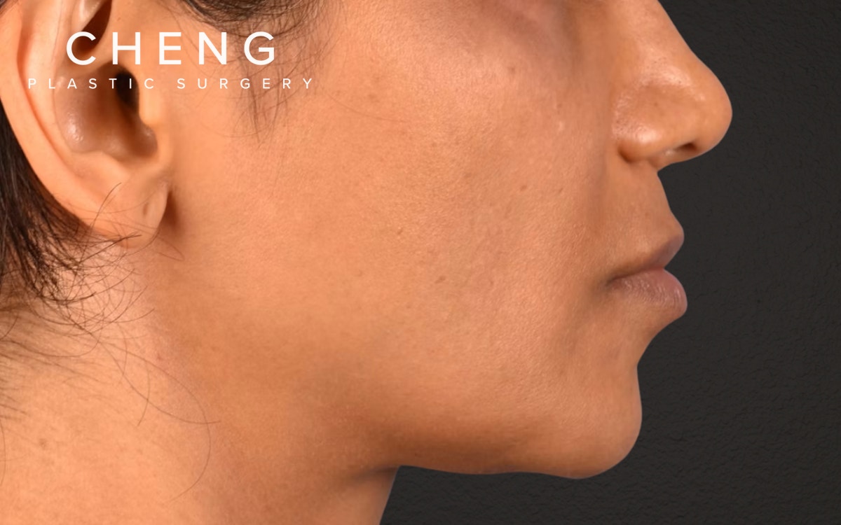 Lip Lift Before & After Gallery - Patient 369454 - Image 7