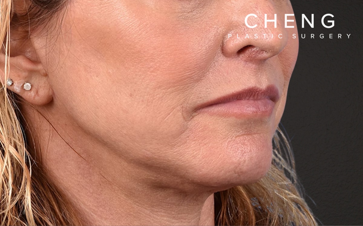 Lip Lift Before & After Gallery - Patient 135816 - Image 4