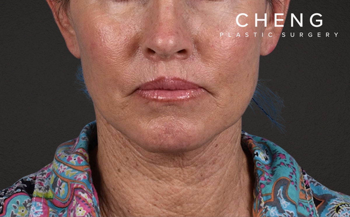 Lip Lift Before & After Gallery - Patient 587833 - Image 2