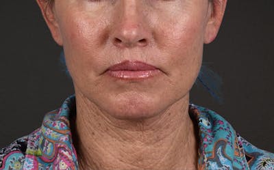 Lip Lift Before & After Gallery - Patient 587833 - Image 2
