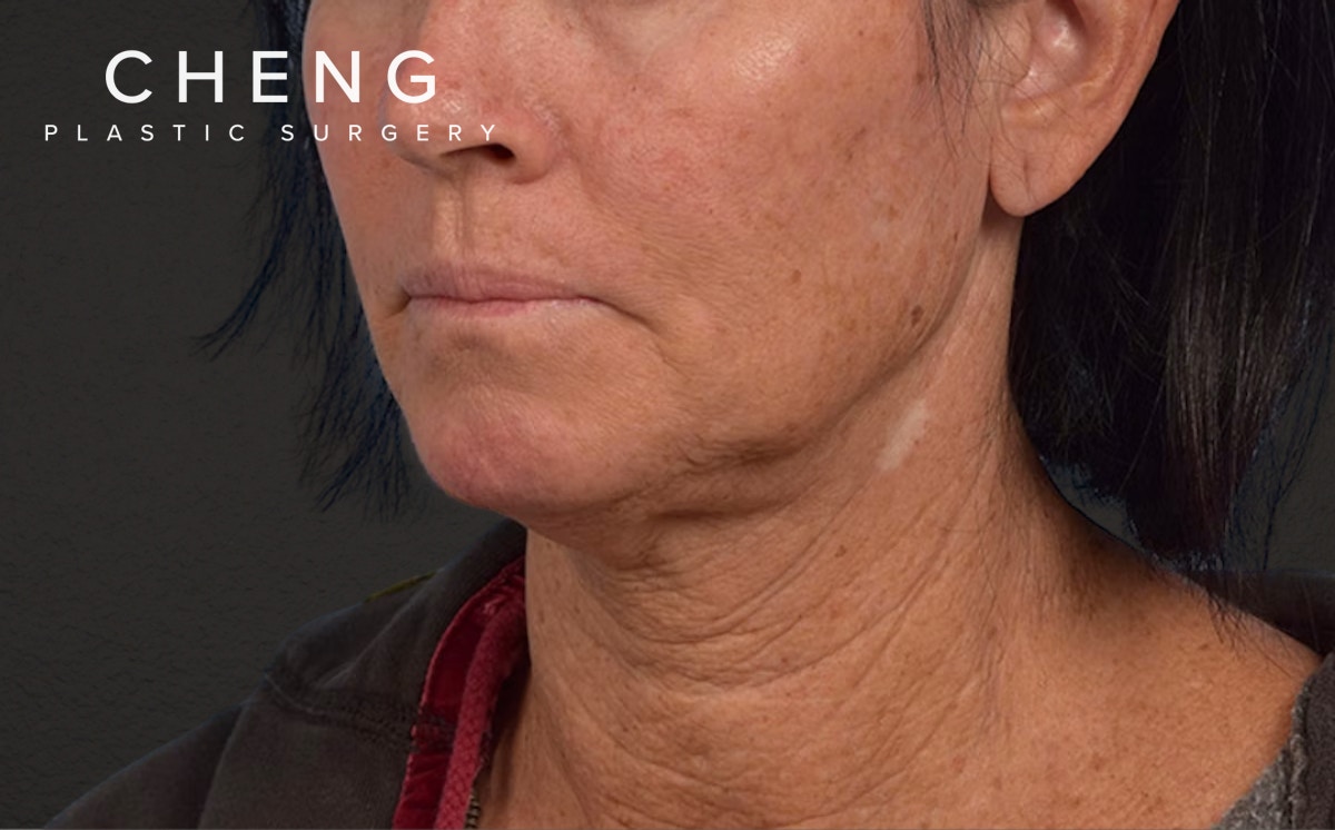 Lip Lift Before & After Gallery - Patient 587833 - Image 3