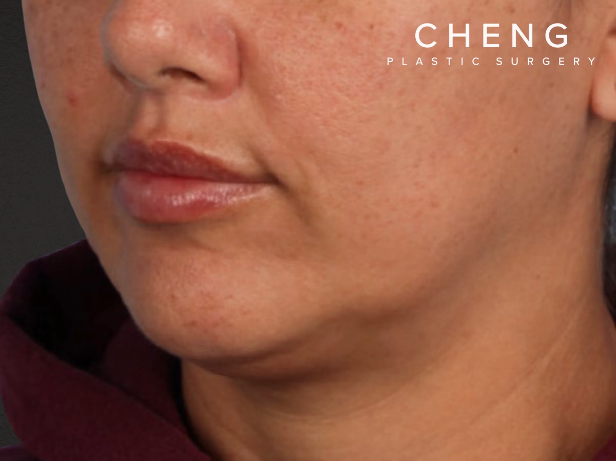 Lip Lift Before & After Gallery - Patient 191794 - Image 2