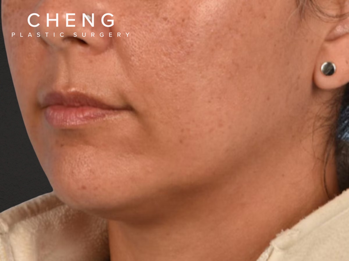 Lip Lift Before & After Gallery - Patient 191794 - Image 1