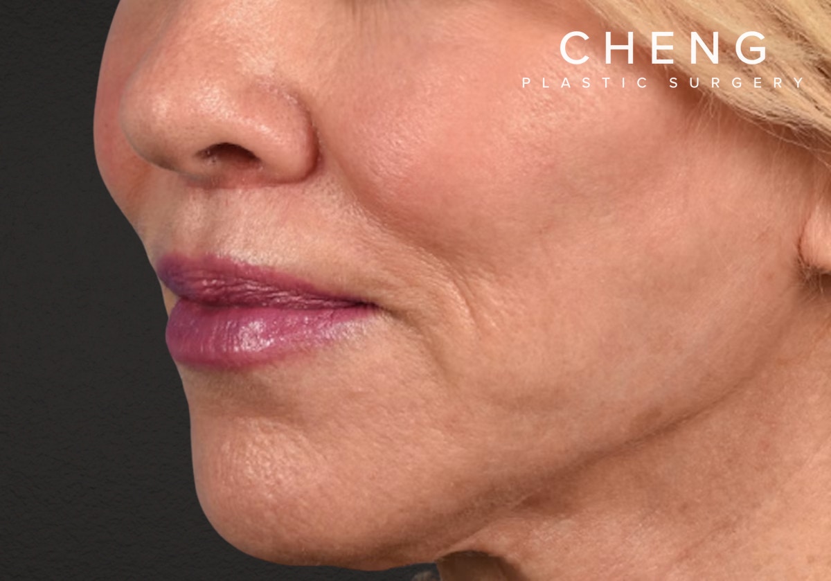 Lip Lift Before & After Gallery - Patient 698728 - Image 2